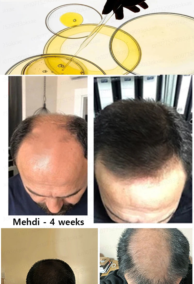 Men’s Hair Regrowth Essential Oil – Targets Bald Spots & Hair Loss, Boosts Thickness Naturally