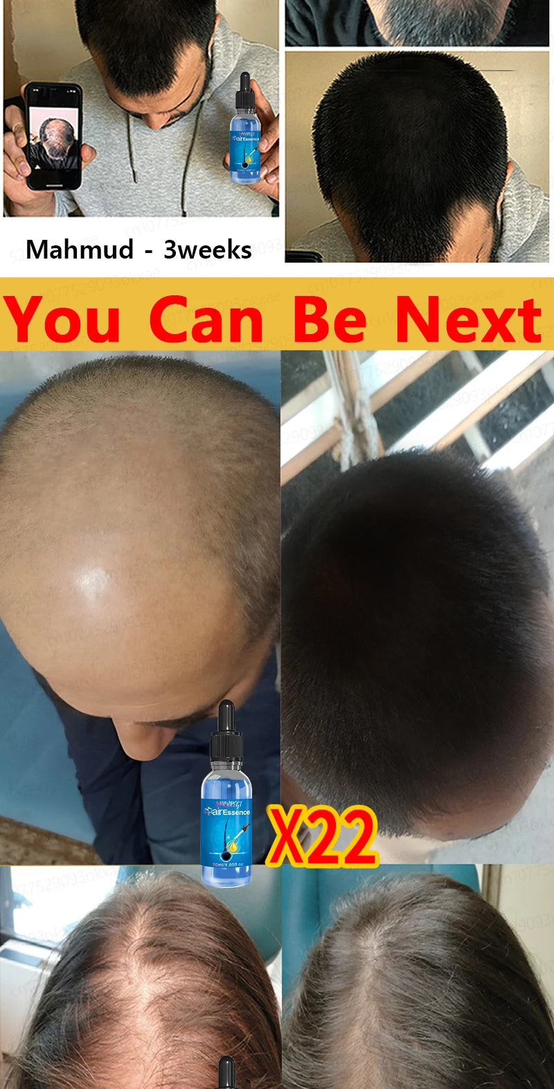Men’s Hair Regrowth Essential Oil – Targets Bald Spots & Hair Loss, Boosts Thickness Naturally
